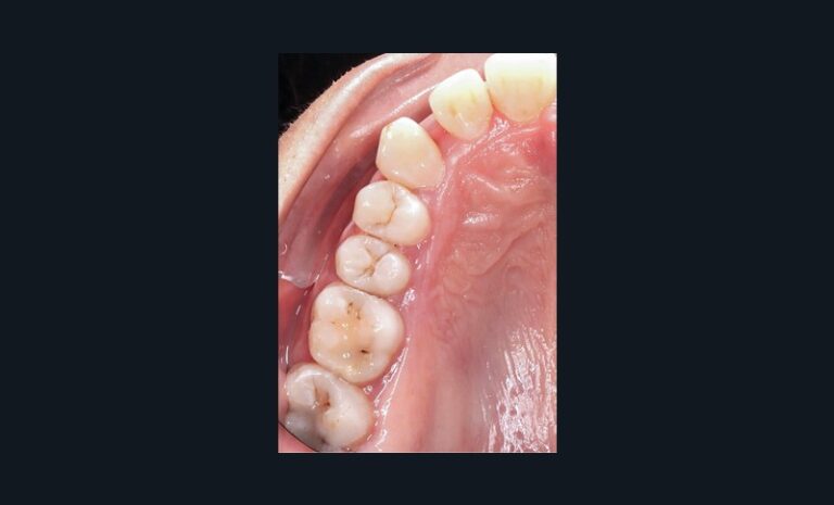 3c. Création de l’espace en mésial de la canine par l’effet du recul avec les aligneurs.