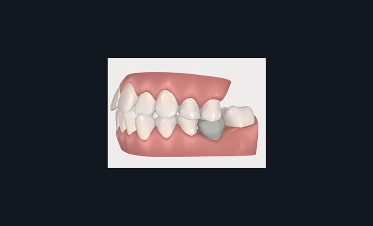 4a. L’ingression de la 36 avec les seuls aligneurs est totalement utopique. Cependant, la simulation virtuelle donne l’illusion d’une ingression sans réaction au niveau des dents servant d’ancrage.