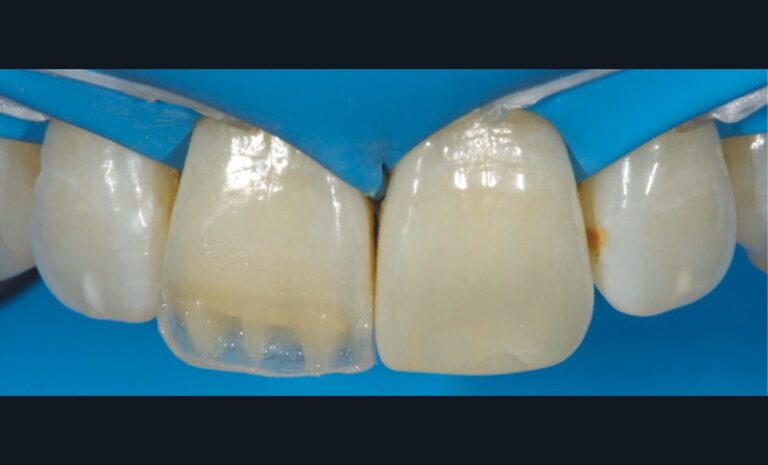 h. Réalisation des lobes dentinaires en résine composite (Medium Dentin).