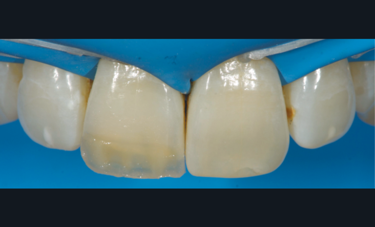 j. Application d’une masse effet opalescente dans la partie terminale incisale entre les fusées de dentine (Opalescent Modifier).