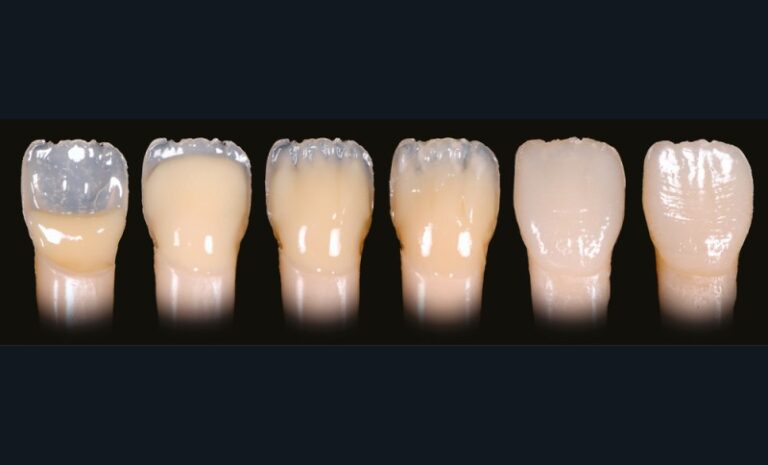 2. Pas à pas d’une stratification anatomique aux résines composites.