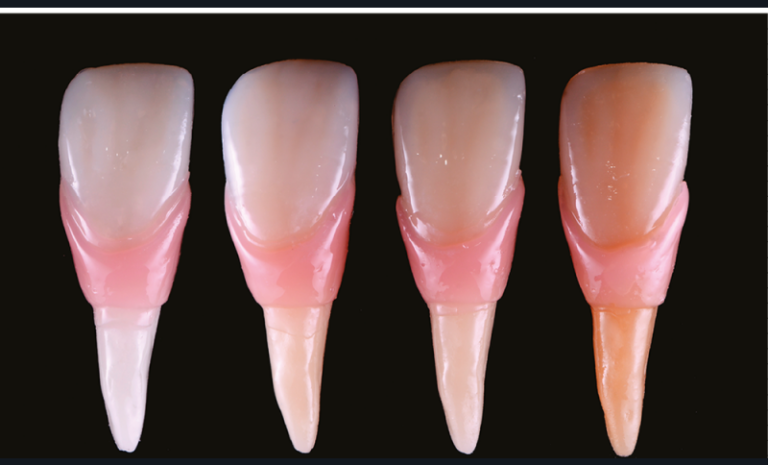 c. Échantillons améliorés à 3 zones distinctes de relevé colorimétrique,  une zone coronaire offrant la prévisualisation de la dentine combinée à l’émail, une zone gingivale et une zone radiculaire de masse dentinaire pure.