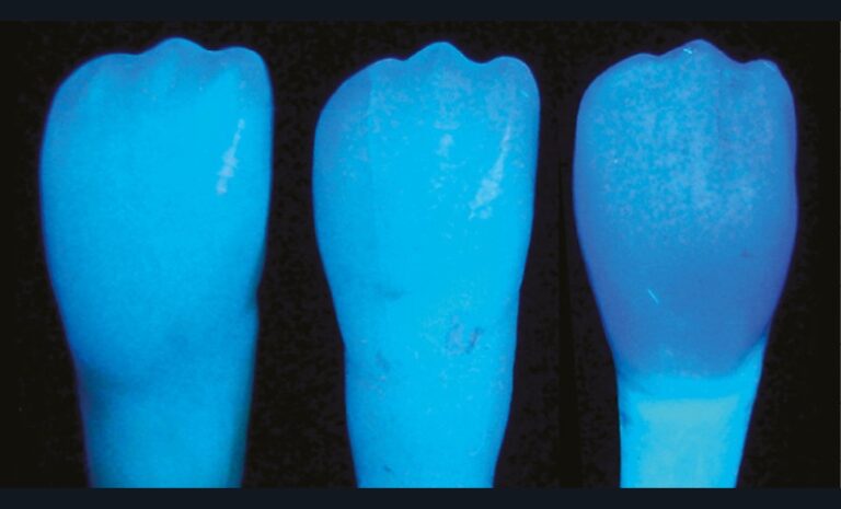 4. Illustration de l’imitation d’une dent naturelle (au centre) sous lumière UV par un système de résine composite à la fluorescence calibrée (à gauche) ou, a contrario, le décalage colorimétrique d’un système de résine composite ne prenant pas en compte les propriétés de fluorescence des tissus dentaires (à droite).