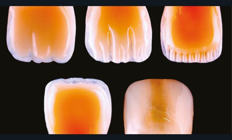 5. Les cinq patterns de fusées dentinaires selon le Dr Lorenzo Vanini.