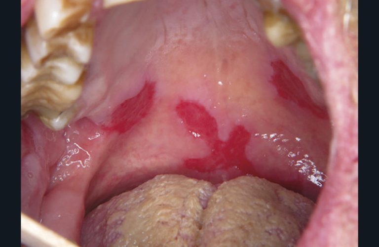 2. Érosions palatines multiples dans un pemphigus vulgaire.