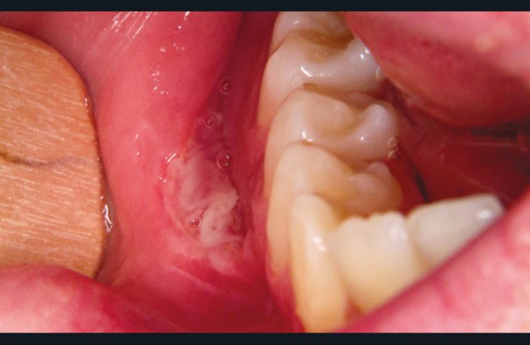 13. Ulcération linéaire de la maladie de Crohn.