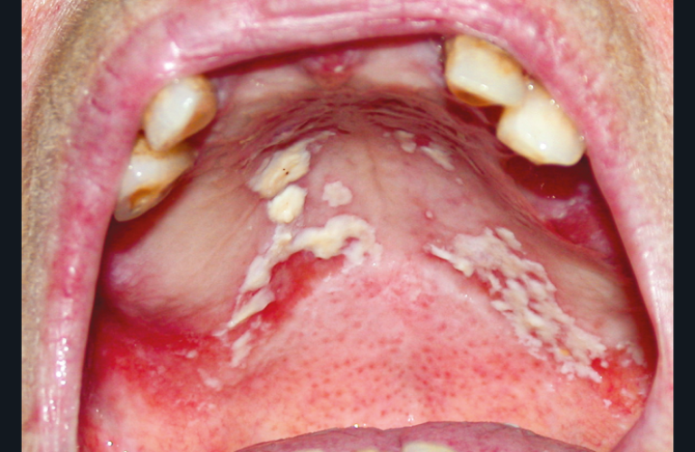 22. Candidose aiguë palatine.