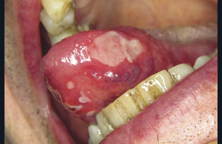 25. Mucite aphtoïde secondaire à un traitement par inhibiteur de mTor.