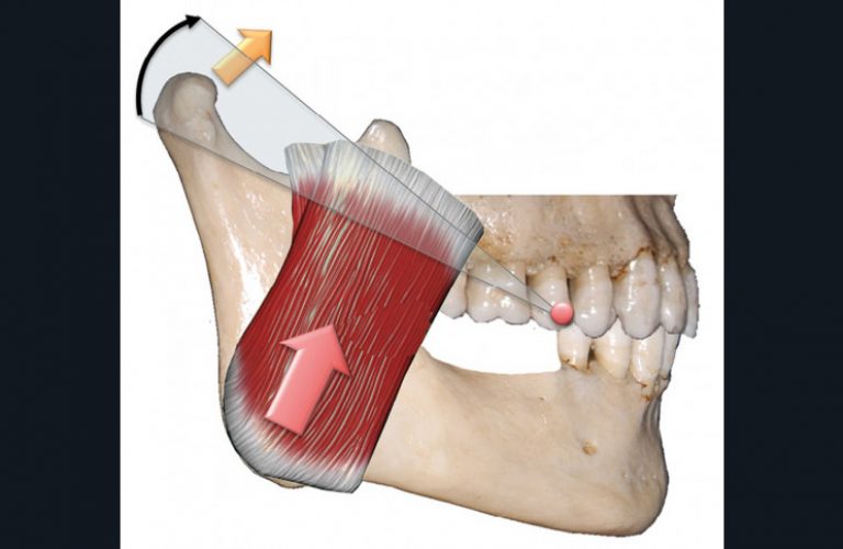 8. Perte de calage postérieur sans perte de DVO : en cas d’activité musculaire élévatrice intense, il existe une rotation mandibulaire horaire ayant pour centre le contact occlusal de la dent terminale, ce qui exposerait l’ATM à des risques de compression.