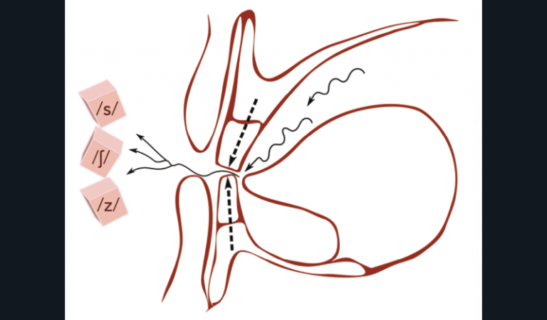 23. Coupe sagittale de la cavité orale avec opposition des bourrelets antérieurs maxillaire et mandibulaire lors de la prononciation du phonèmes /s/ avec recherche de chuintement (/ƒ/) et du zozotement (/z/).