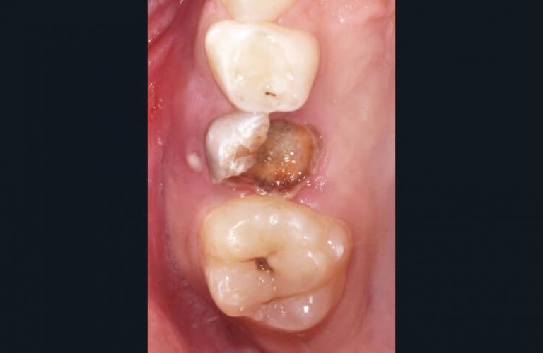 b) Situation clinique des dents postérieures maxillaires droites.