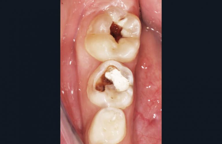 c) Situation clinique des dents postérieures mandibulaires droites.