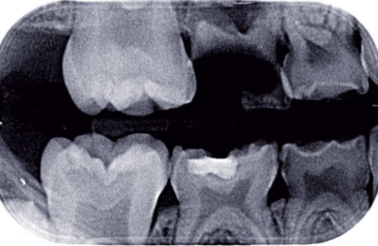 d) Radiographie rétro-coronaire droite correspondante.