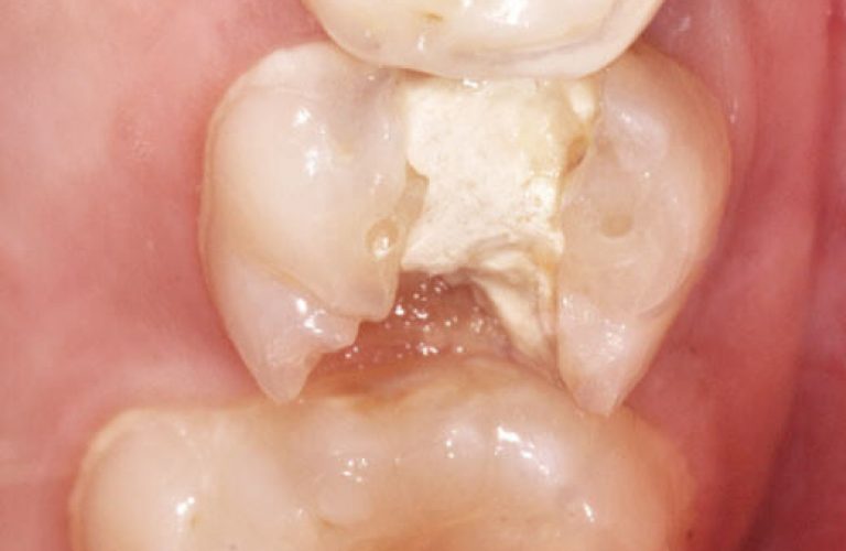 e) Situation clinique des dents postérieures maxillaires gauches.