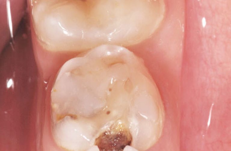 f) Situation clinique des dents postérieures mandibulaires gauches.