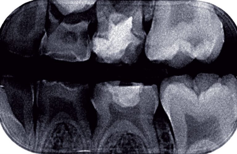 g) Radiographie rétro-coronaire gauche correspondante.