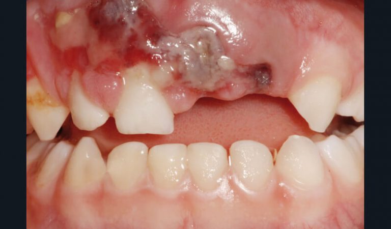Fig. 7
 a) Cas clinique 2. Vue clinique d’un traumatisme dento-alvéolaire (expulsion de 61, 62, luxation latérale de 51) survenu suite à une chute chez un enfant de 4 ans.