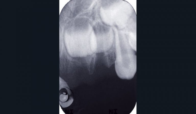 b) Radiographie rétroalvéolaire objectivant l’expulsion des dents 61 et 62.