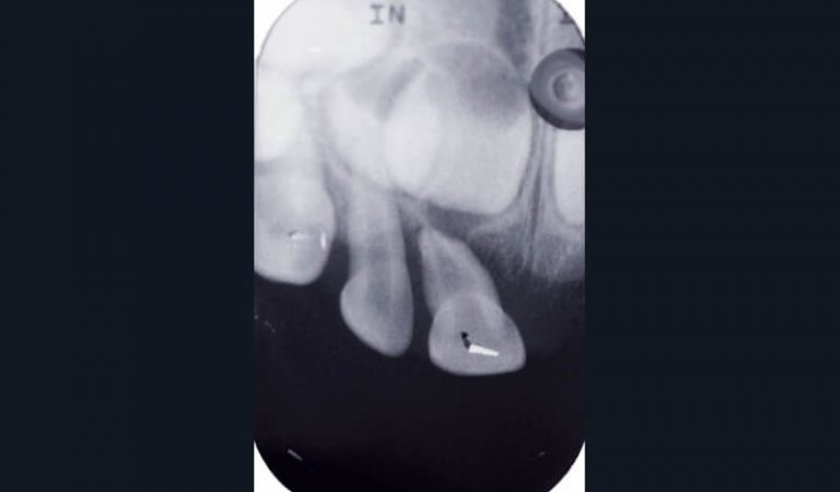 c) Radiographie rétroalvéolaire objectivant l’état dento-alvéolaire des dents 51 et 52.