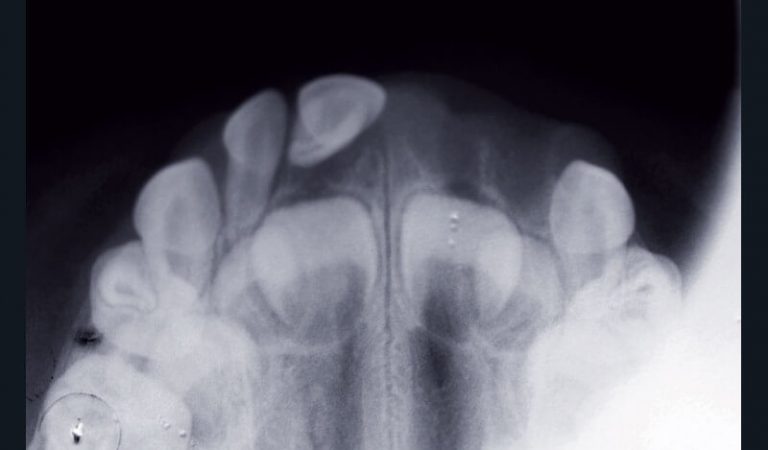 d) Incidence occlusale correspondante.