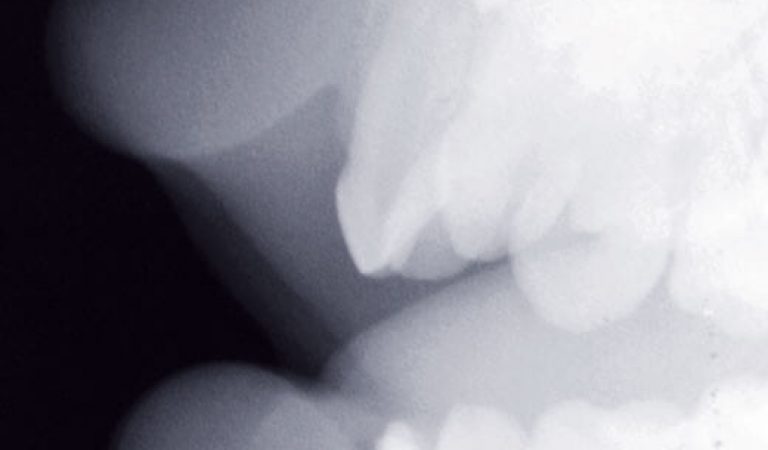 e) Cliché extra-oral latéral permettant de montrer le déplacement de l’apex de 51 en direction labiale. Ce cliché latéral confirme l’absence de fragments dentaires ou de corps étrangers au niveau des lèvres